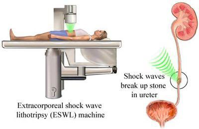 eswl machine